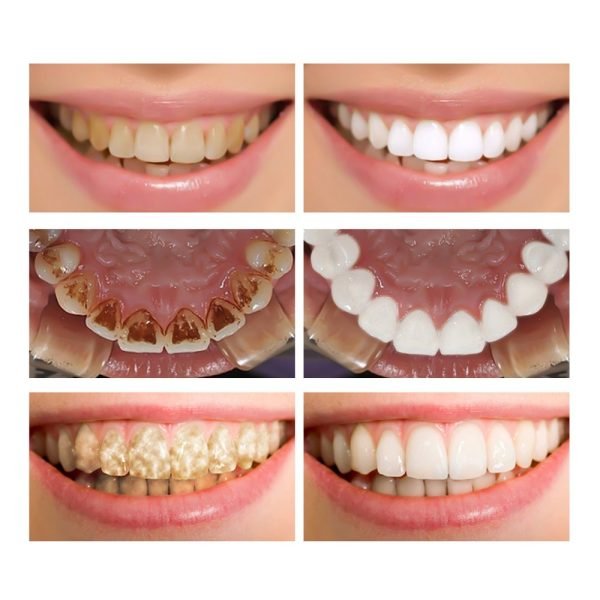 FTEENPLY Tooth Whitening Essence with 10 cotton swabs - Image 5
